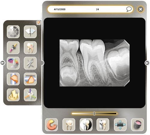 Podgląd zdjęcia uzyskanego za pomocą radiowizjografii Acteon SOPIX