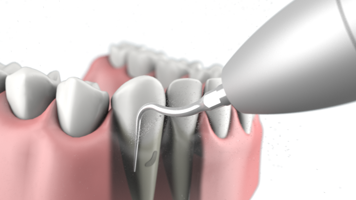 Czyszczenie zębów piaskarko-skalerem