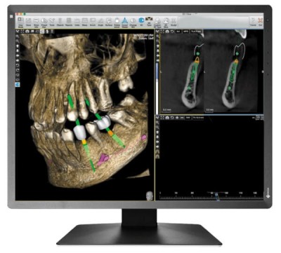 Monitor stomatologiczny Eizo Radiforce MX216HB ze zdjęciem podglądowym