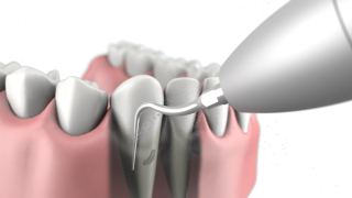 Skaler Q6 2.0  - piaskowanie