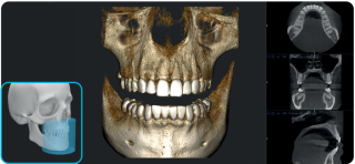Acteon X-Mind Optima CORE 3D Pano Ceph