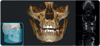 Acteon X-Mind Optima CORE 3D Pano Ceph