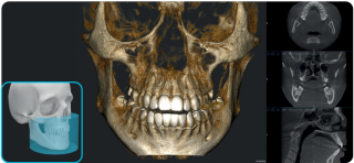 Acteon X-Mind Optima CORE 3D Pano Ceph