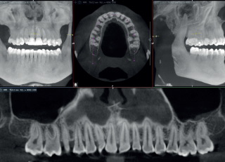 Acteon X-Mind Optima CORE 3D Pano Ceph