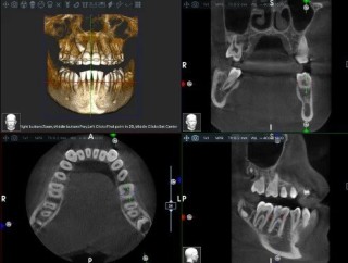 Acteon X-Mind Optima CORE 3D Pano Ceph