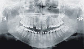 Acteon X-Mind Prime Pan Ceph - zdjęcie wykonane u pacjenta z aparatem ortodontycznym