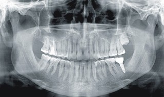 Acteon X-Mind-Prime Pan Ceph - zdjęcie implantu