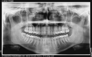Acteon X-Mind Prime z cefalo
