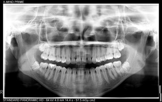 Zdjęcie wykonane za pomocą Acteon X-Mind Prime 2 Pan 3D